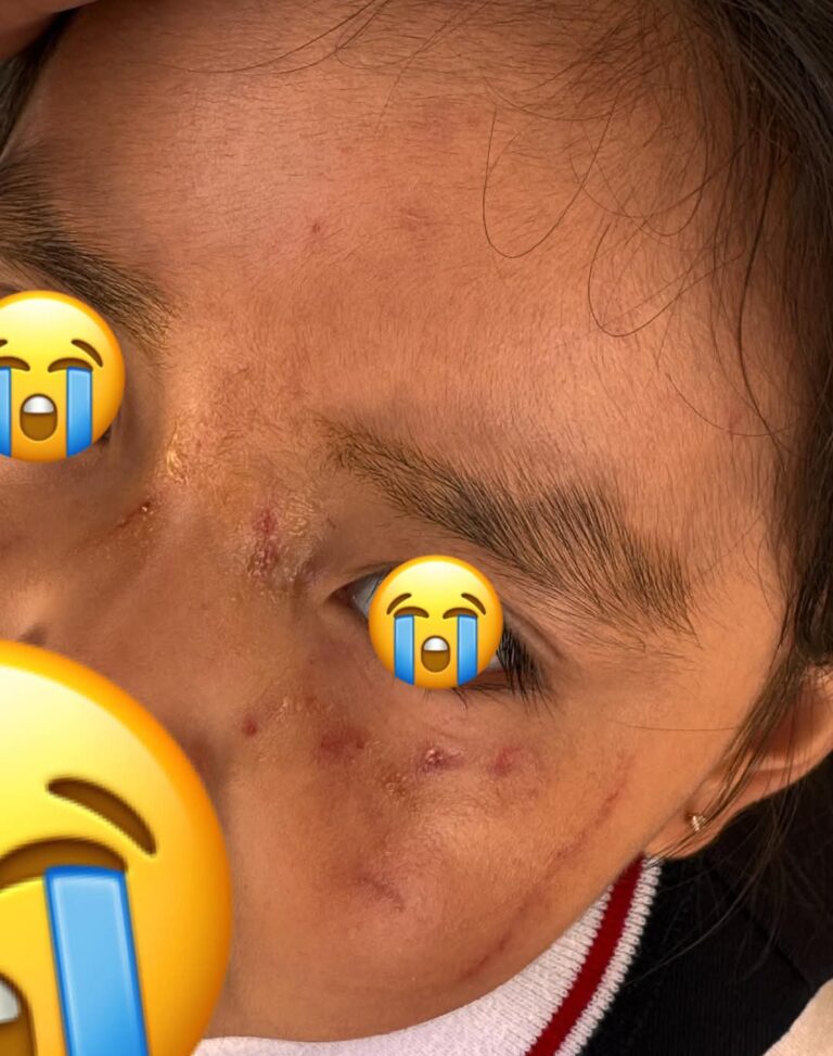 Le desfiguran la cara a niña en kínder de San Andrés
