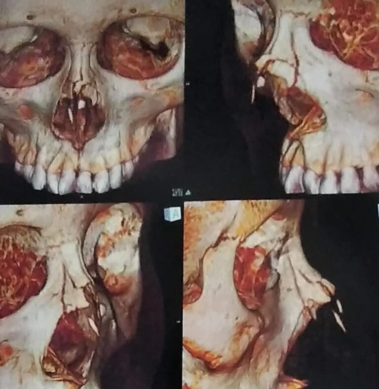 Le rompen la …… nariz a estudiante en secundaria antorchista de Ocoyucan 