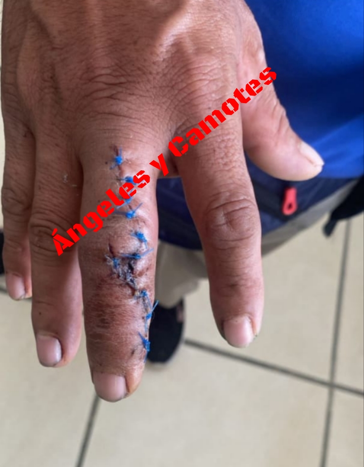 Por cobrar una deuda a su “amigo”, lo machetean en Hueytamalco