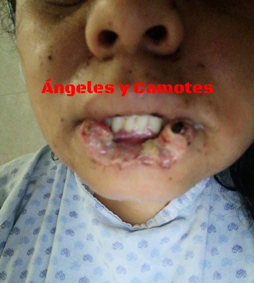 ¡Que enfermo! Le arrancó el labio a mordidas y casi la mata en Huejotzingo 